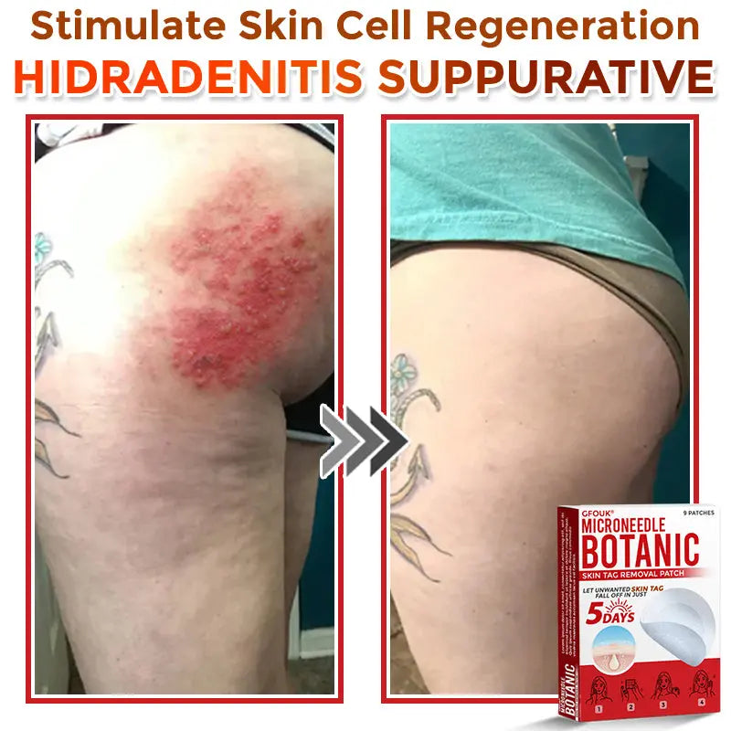 Natrvor –2-in-1 Microneedle Botanical Skin Renewal Patch