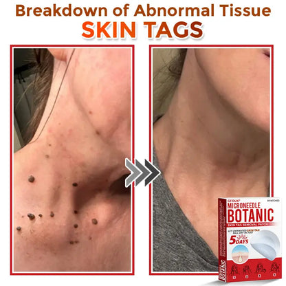 Natrvor –2-in-1 Microneedle Botanical Skin Renewal Patch